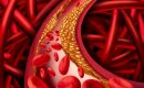 ATHEROSCLEROSIS