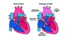 tetralogy of Fallot