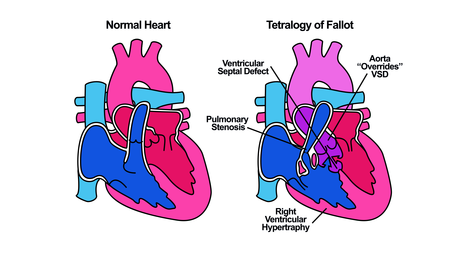 tetralogy of Fallot