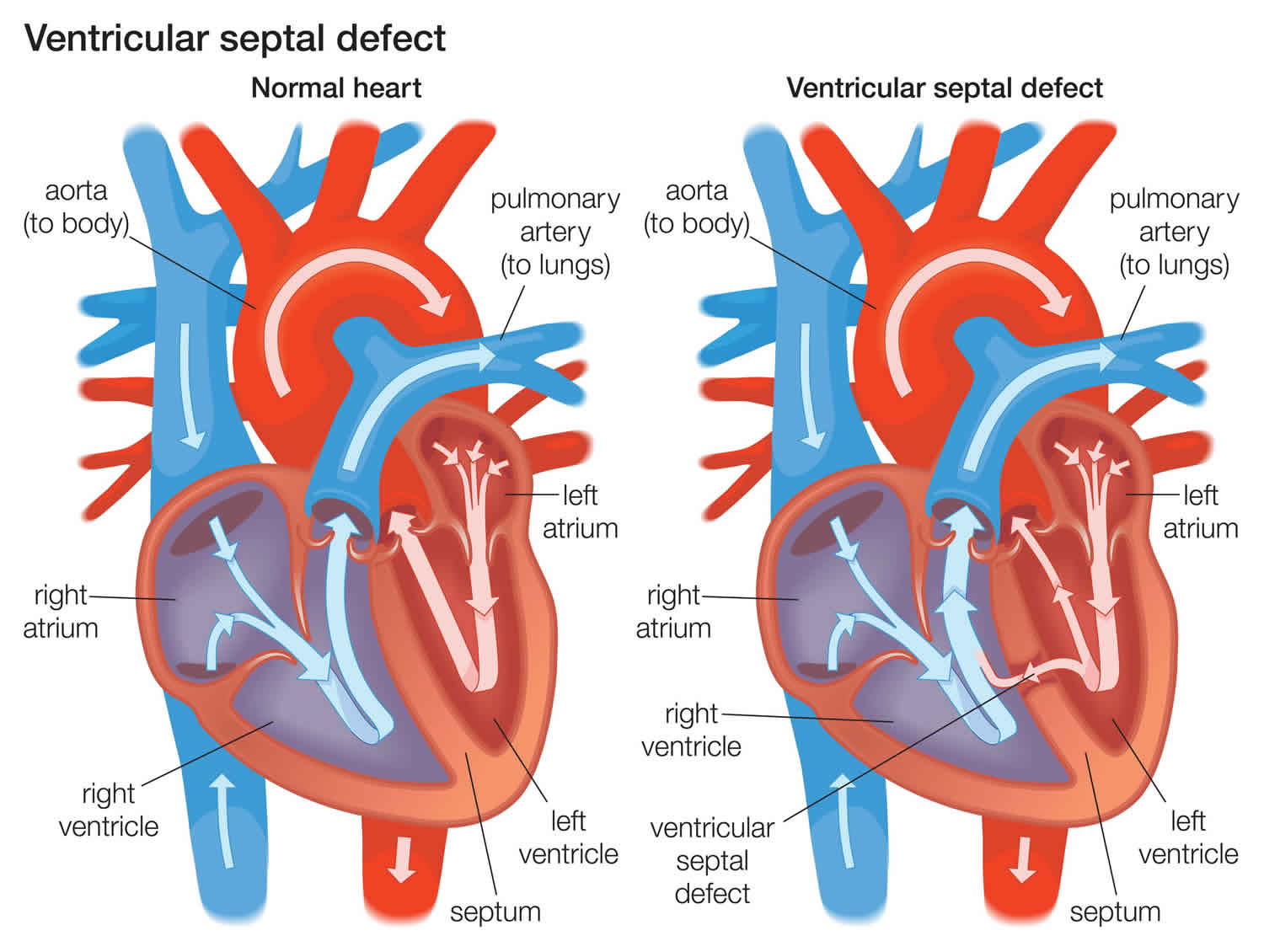 VENTRICULAR SEPTAL DEFECT