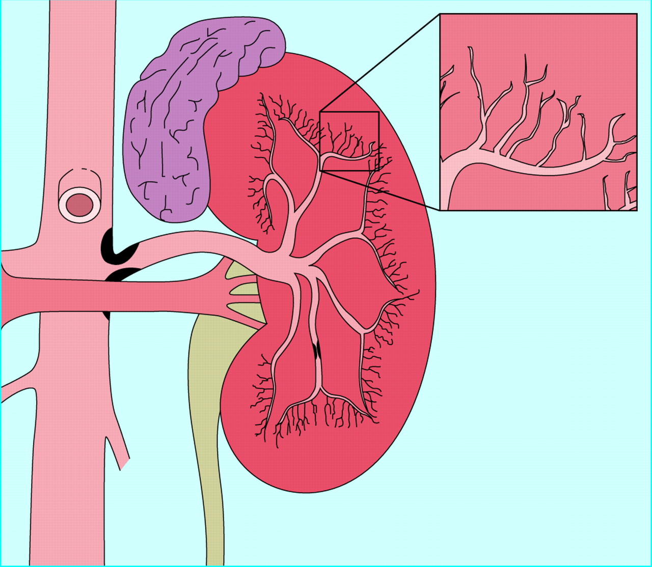 Renal artery stenosis